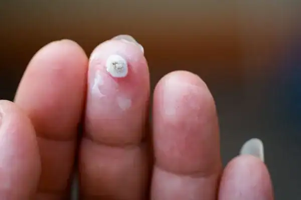 Image of white wart before cryopen treatment Northwich
