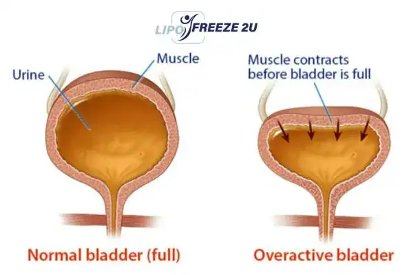 diagram of overactive bladder treatment Northwich