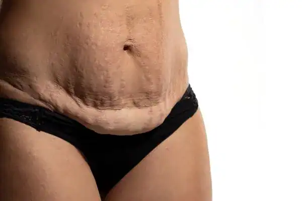 loose skin after weight loss injections Northwich