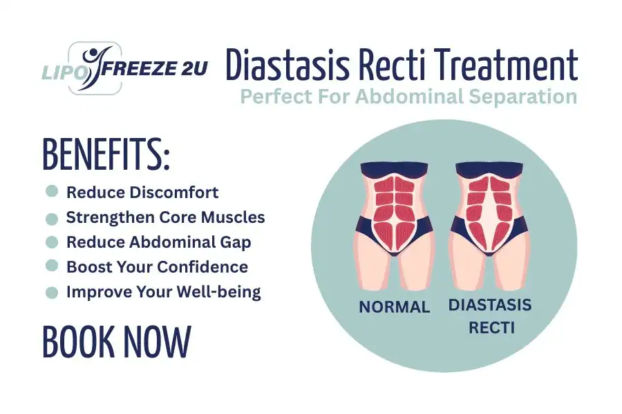 How Long Will It Take to See Improvements in Diastasis Recti Northwich