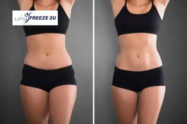 How Can LIPO FREEZE 2U Support Your Post-Pregnancy Body Recovery Northwich?