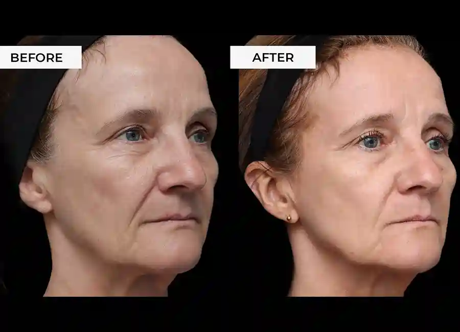 How Many RF Microneedling Sessions Will You Need to See a Difference Northwich?