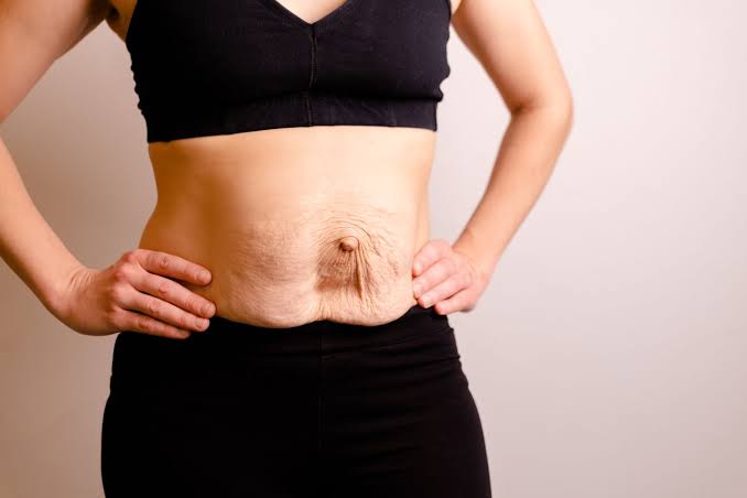 Is Surgery Really the Only Way to Repair Diastasis Recti Northwich?
