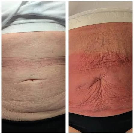 How Does RF Microneedling Improve Crepey, Thin and Uneven Skin Texture Northwich?