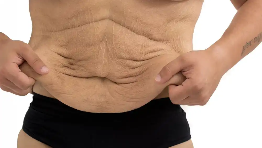 RF Microneedling for Loose Skin: How Can It Help Tighten and Reshape the Skin Northwich?